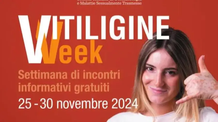 La 'Vitiligine Week' arriva in Calabria: incontri gratuiti con i dermatologi