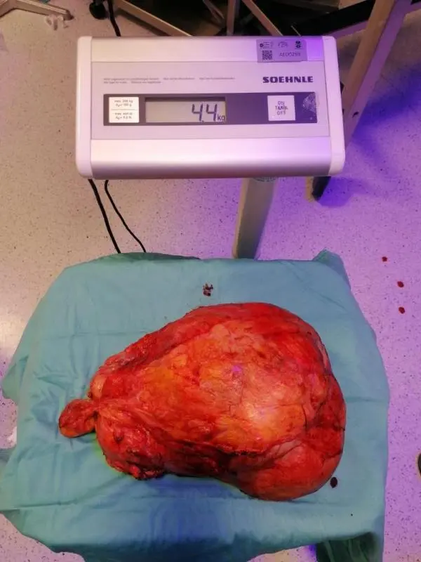 images Cosenza, ospedale Annunziata: asportato tumore di 4 kg e mezzo